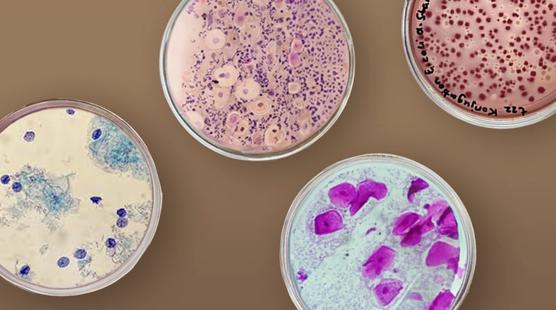 Bacterial Vaginosis vs Yeast Infection vs Cytolytic Vaginosis
