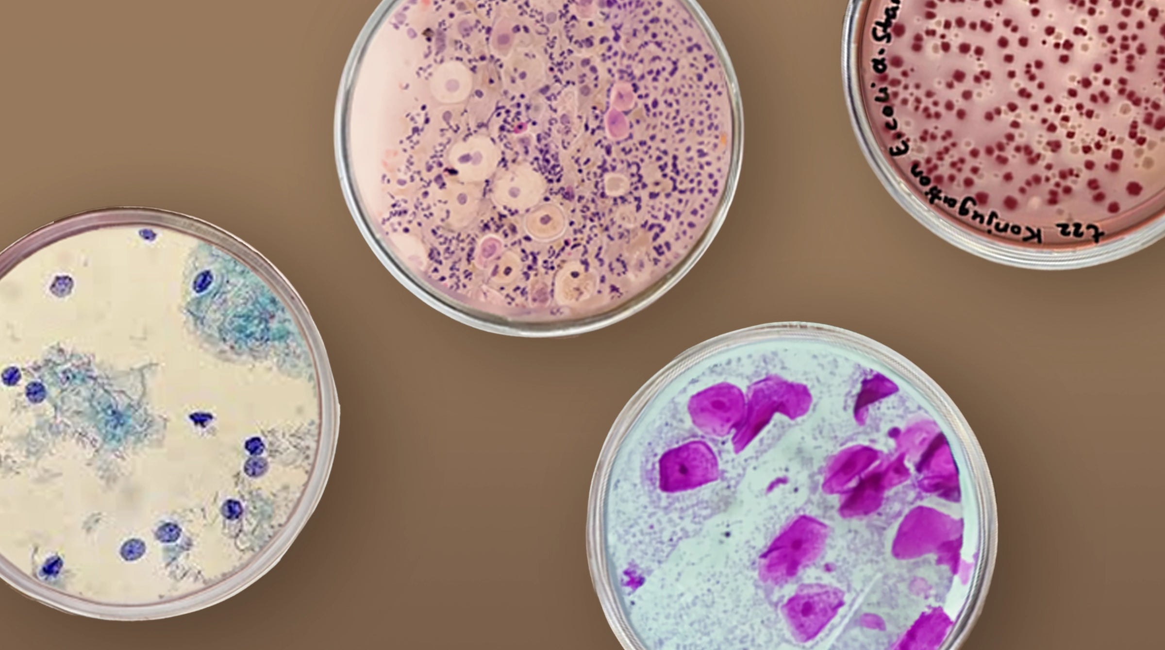 Bacterial Vaginosis vs Yeast Infection vs Cytolytic Vaginosis
